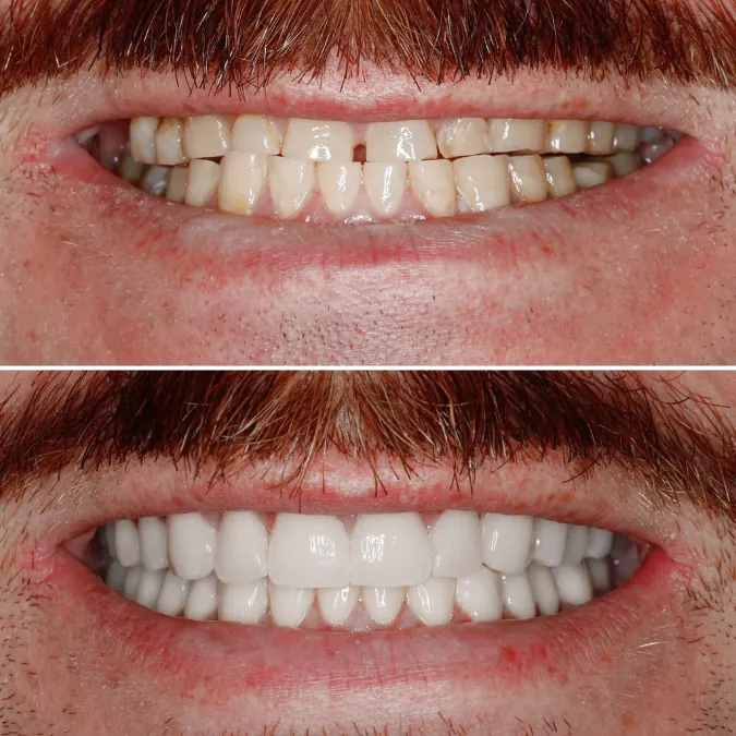 SMYLE patient transformation 2